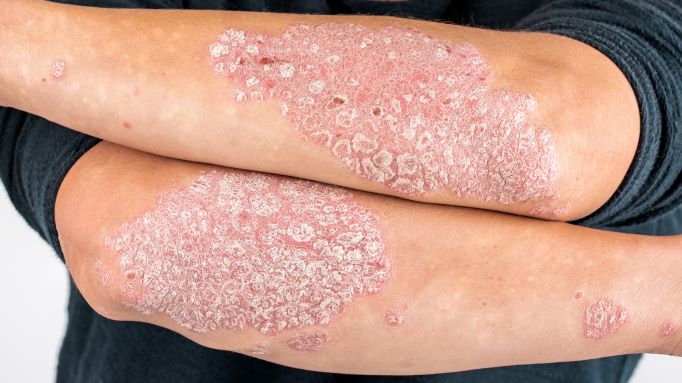 Curcumin-based therapeutic potential of Curcuma longa in the management of psoriasis